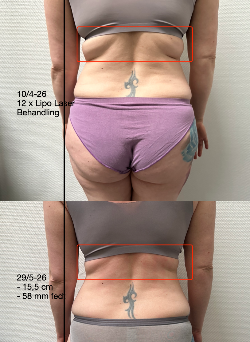 Foer og efter Lipo Laser fedtreduktion